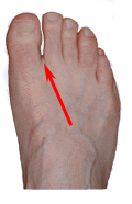 Identifying Morton's Toe